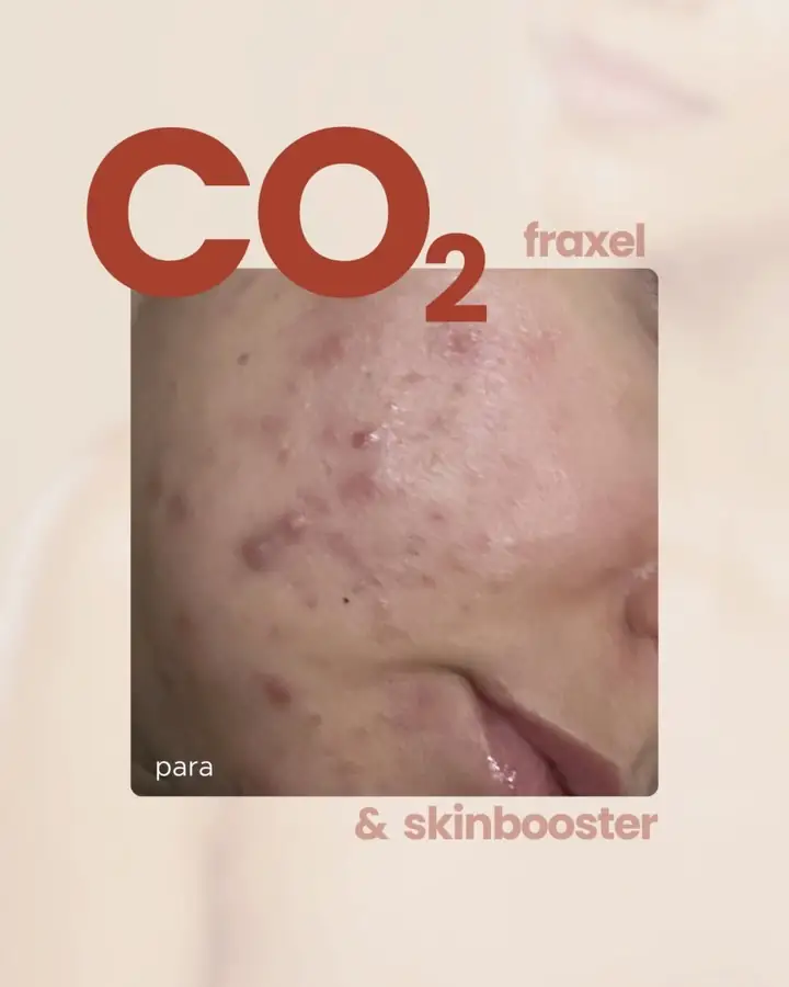 CO₂ + Skinbooster · para & pas