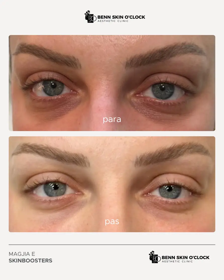 Po, po ky rezultat mund të arrihet me skinboosters.