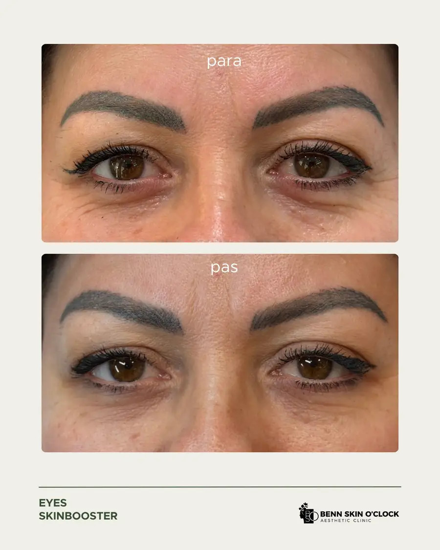 Rezultat i arrirë me skinbooster për sytë 🫶🏻