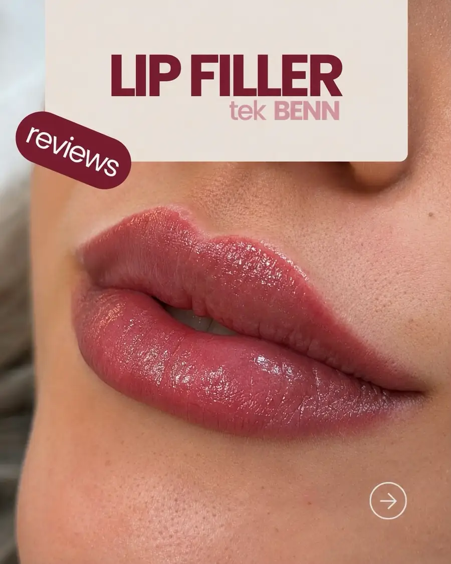 Lip filler reviews 🫶🏻