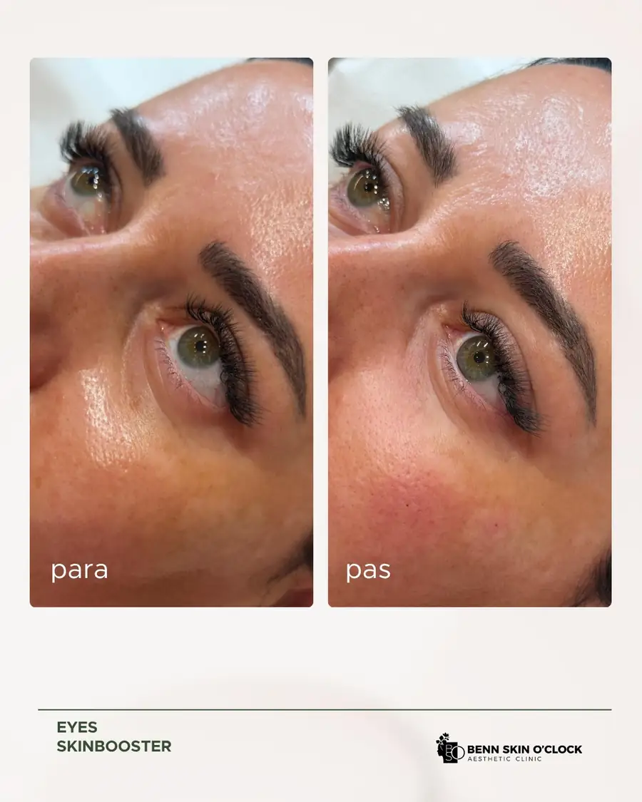 Skinbooster sysh për një pamje më të freskët 🌸