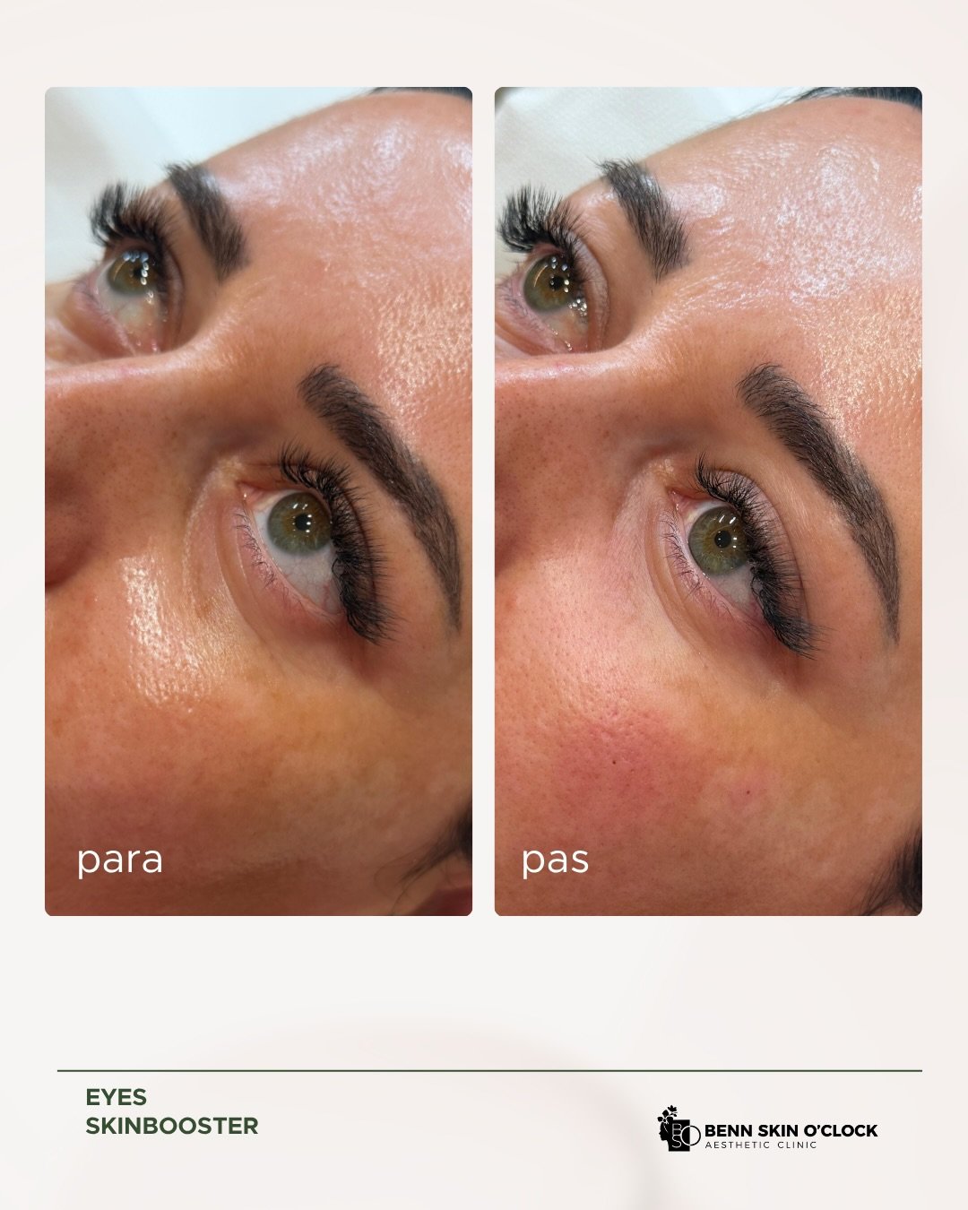 Para dhe pas · Skinbooster