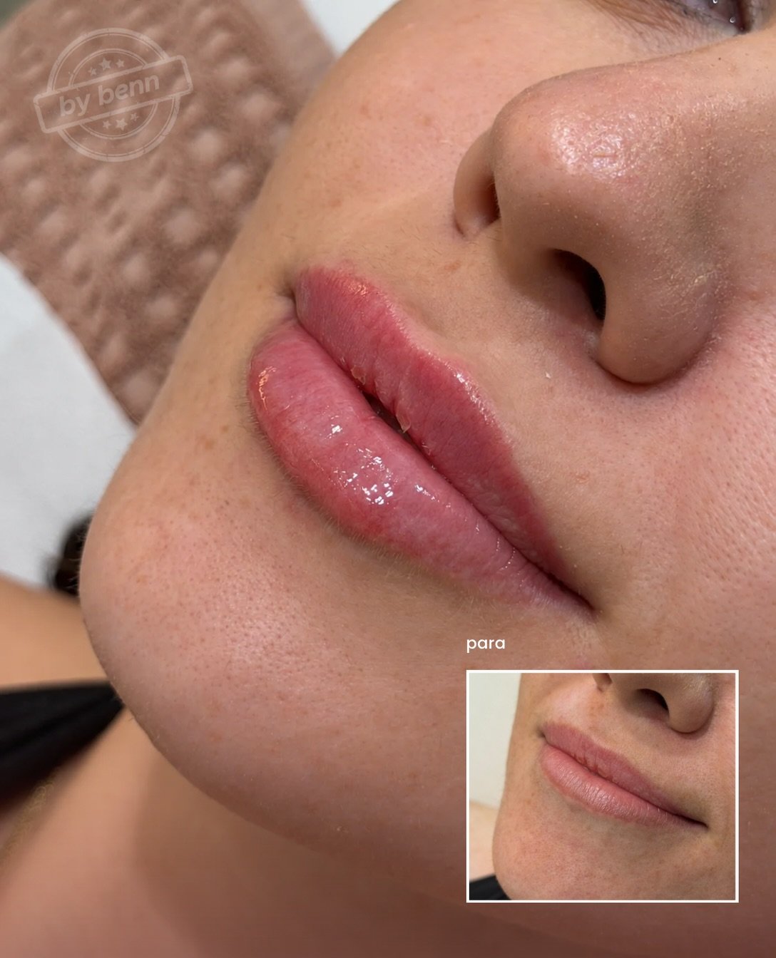 Para dhe pas · Lip filler